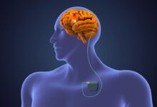 Deep brain stimulation dbs