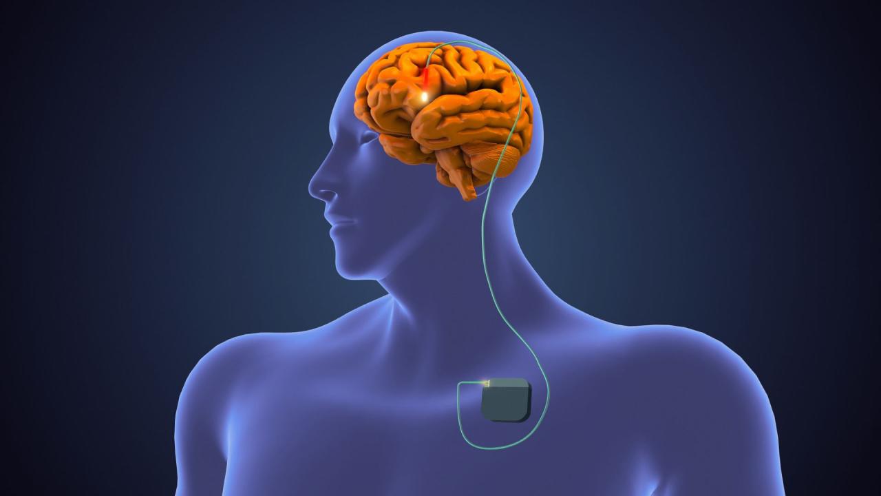 Deep brain stimulation dbs