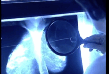 Is thermography a good way to detect breast cancer