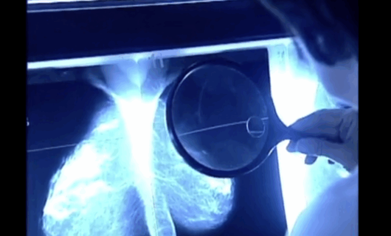 Is thermography a good way to detect breast cancer
