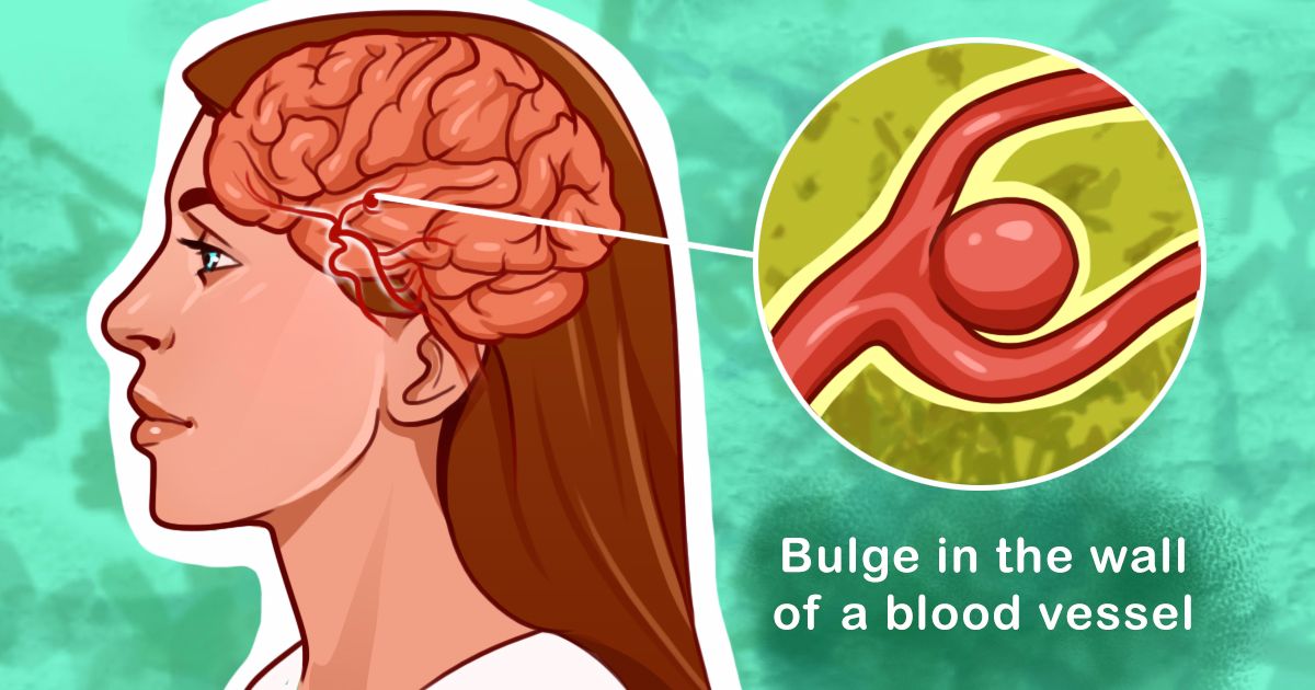 Are brain aneurysms hereditary