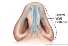 New treatment for nasal passage obstruction doesnt involve surgery