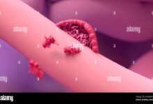 Endometriosis of fallopian tube