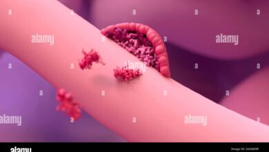 Endometriosis of fallopian tube