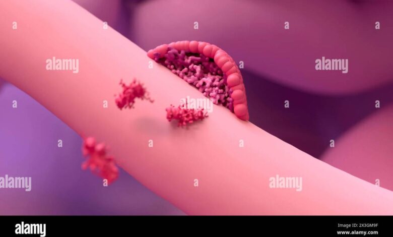 Endometriosis of fallopian tube
