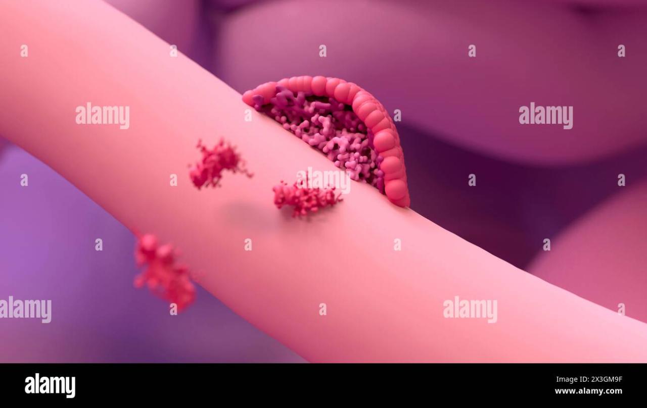 Endometriosis of fallopian tube