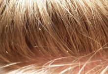 Do head lice jump