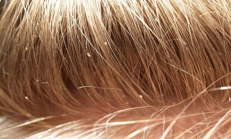 Do head lice jump