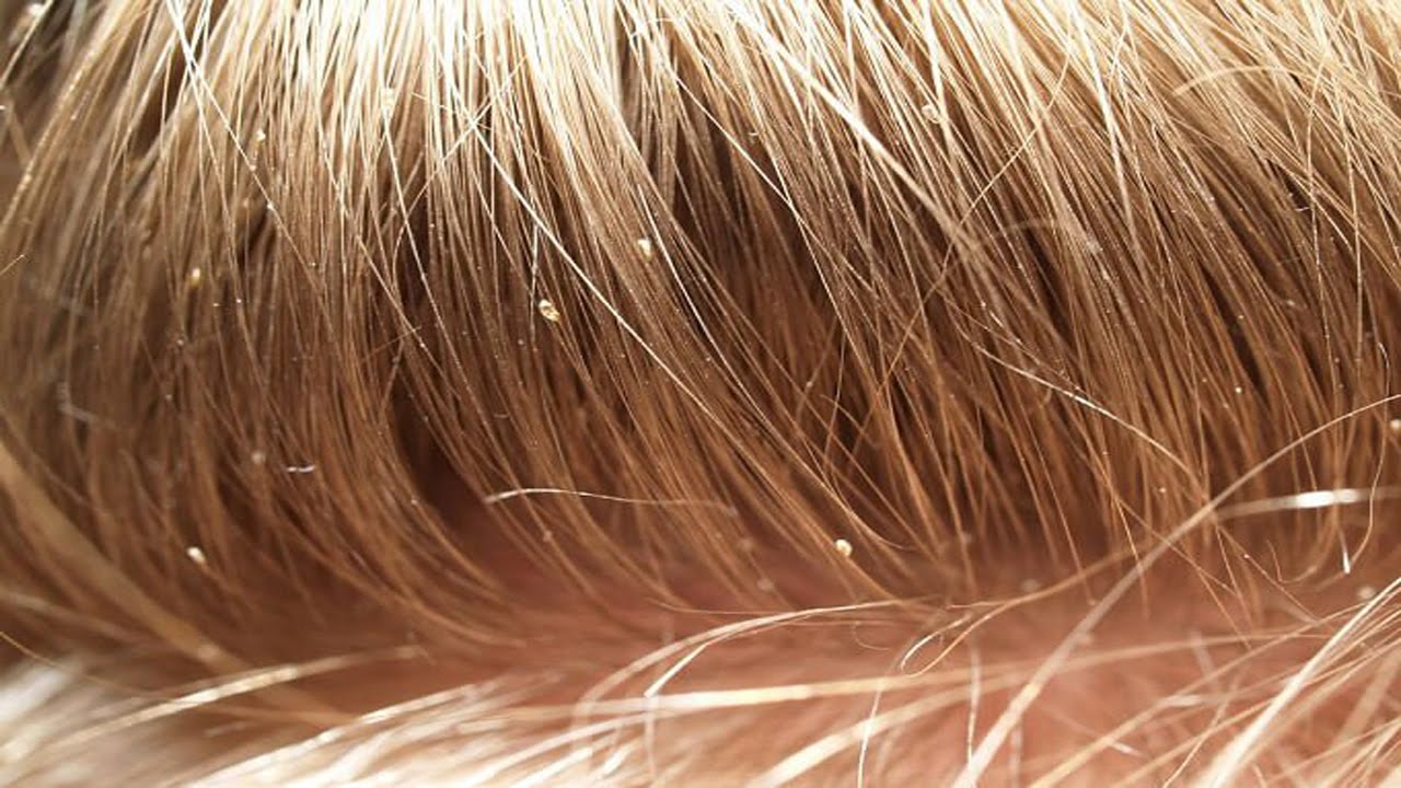 Lice head hair Do head lice jump