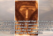 Birth control link to breast cancer