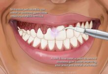 Everything to know about a gingivoplasty