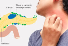 Gallstones could be a warning sign of pancreatic cancer