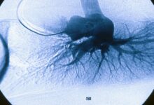 Pulmonary arterial hypertension prognosis