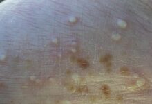 Generalized pustular psoriasis images