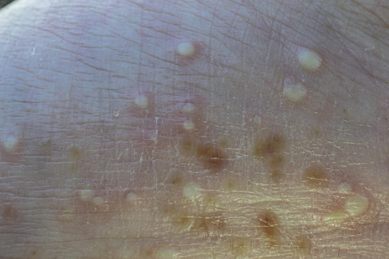 Generalized pustular psoriasis images