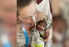 How doctors saved an infant with 3 weeks to live
