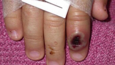 Man with monkeypox develops serious heart issue what to know