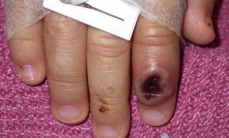 Man with monkeypox develops serious heart issue what to know