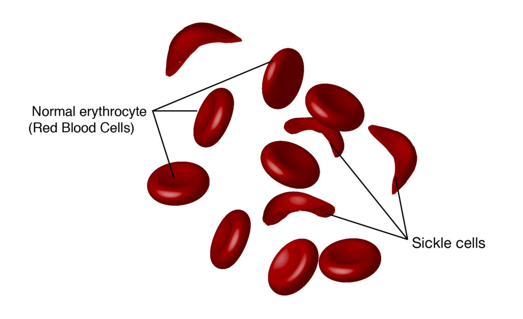 Can sickle cell trait cause symptoms