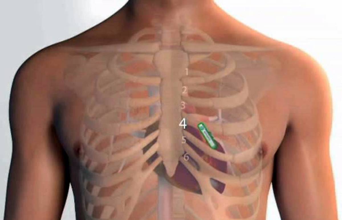 Medtronics implantable insulin pump what you might like to know