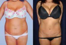 Tuck reduces pain incontinence surgery tummy back