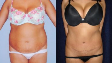 Tuck reduces pain incontinence surgery tummy back