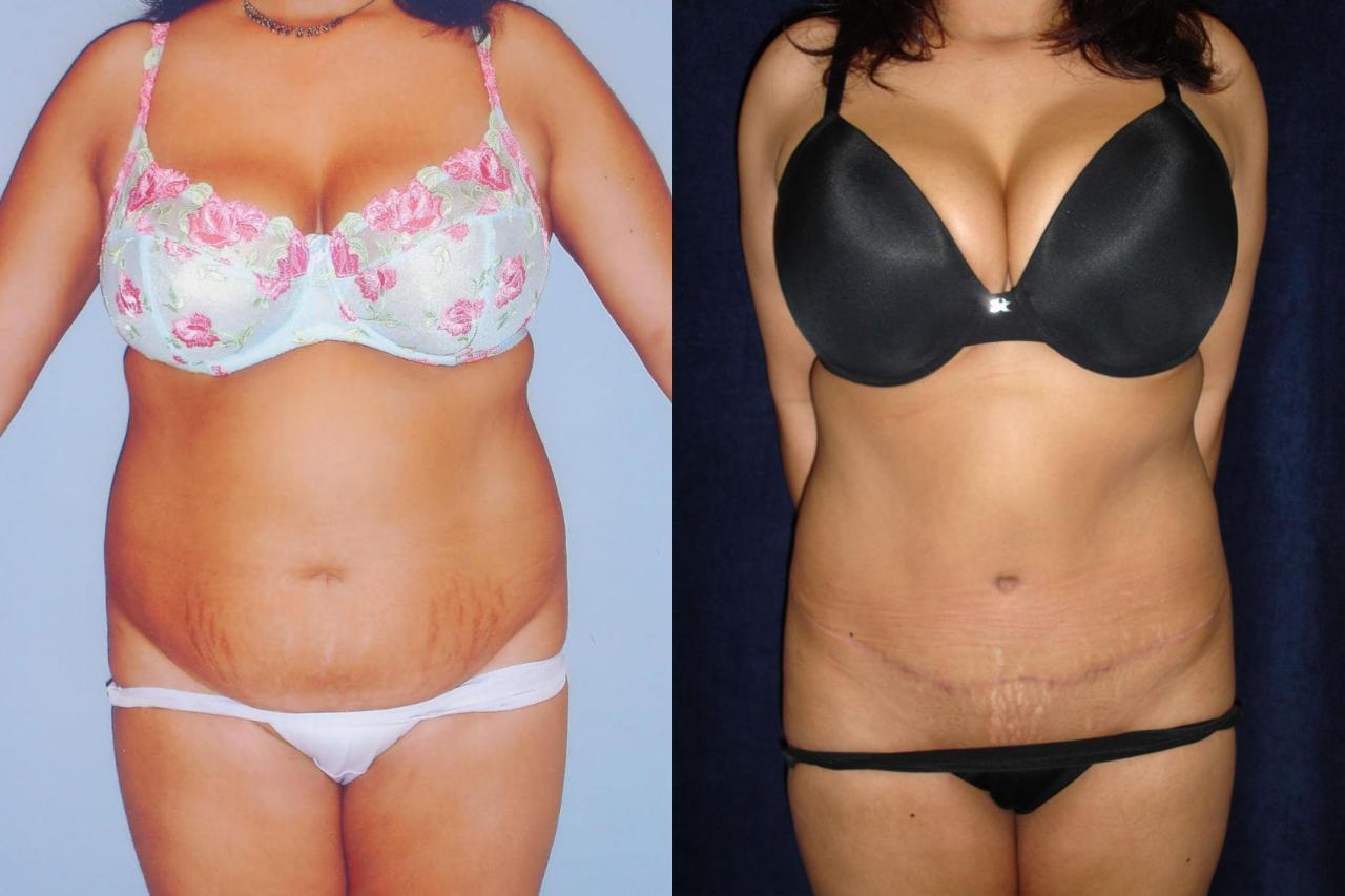 Tuck reduces pain incontinence surgery tummy back Tuck reduces pain incontinence surgery tummy back