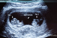 Twins truth sisters birth finds both same give then story family day out twitter facebook