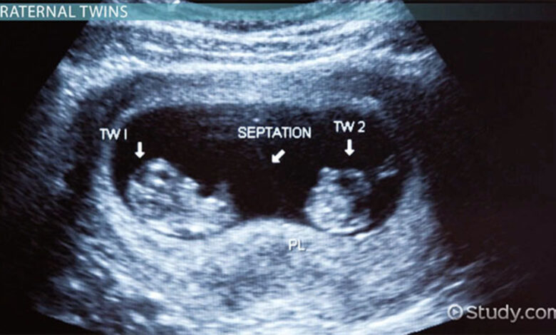 Twins truth sisters birth finds both same give then story family day out twitter facebook