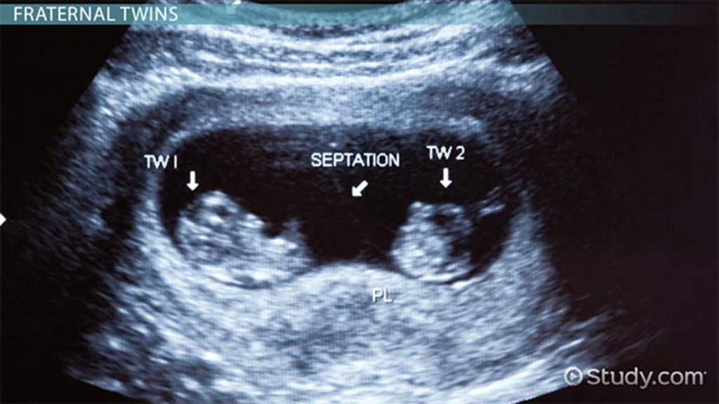 Twins truth sisters birth finds both same give then story family day out twitter facebook Twins truth sisters birth finds both same give then story family day out twitter facebook