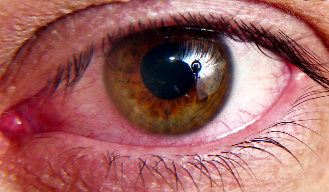 Eye syndrome treat caffeine Caffeine and dry eye disease