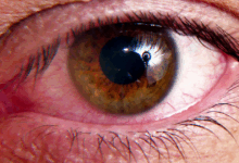 Caffeine and dry eye disease