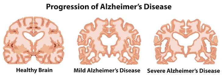 6 things people living with alzheimers want you to know