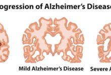 6 things people living with alzheimers want you to know
