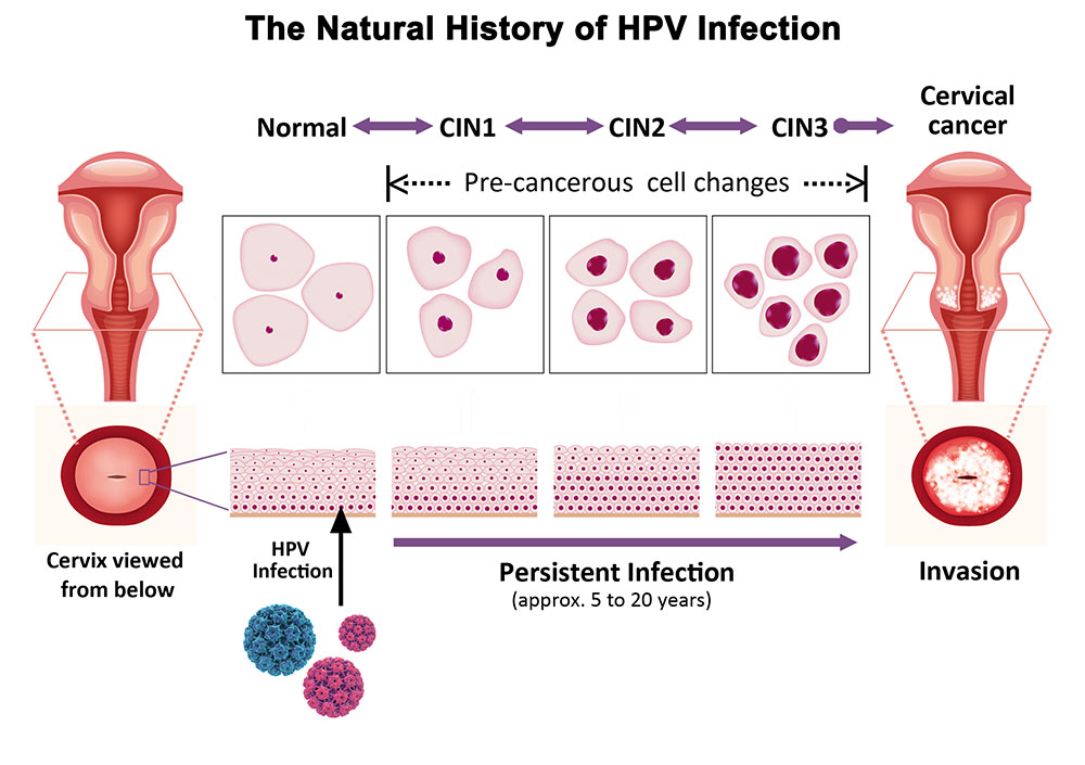 Hpv cervical cancer cin neoplasia intraepithelial cervix epithelial Hpv linked to cervical cancer have declined since the advent of the hpv vaccine