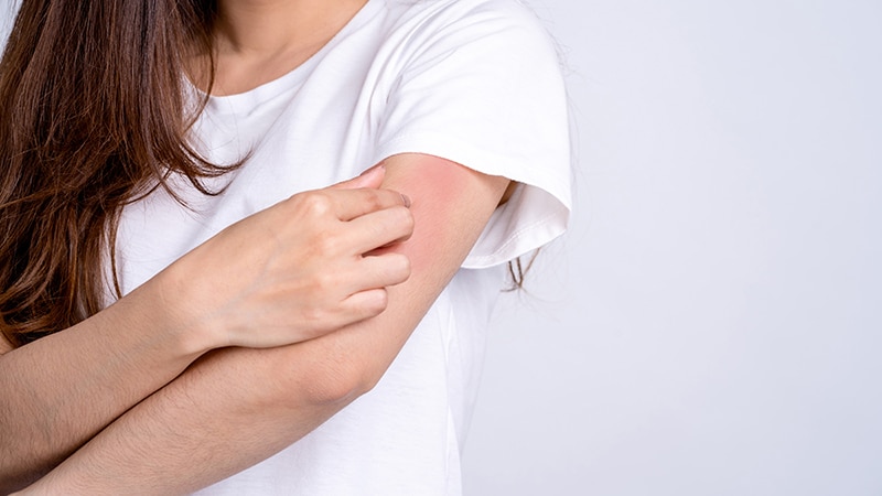 Eczema after covid vaccine