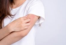 Eczema after covid vaccine