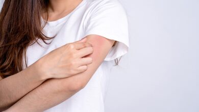 Eczema after covid vaccine