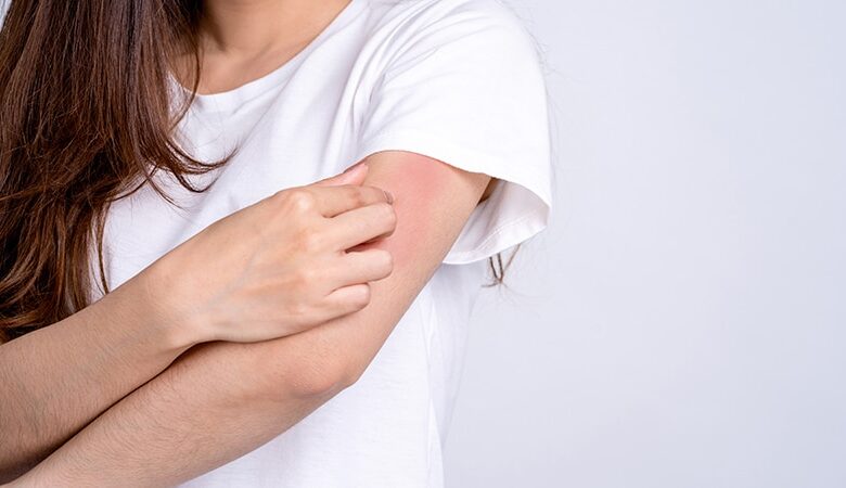 Eczema after covid vaccine