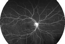 Retinal implant hope of cure for macular degeneration