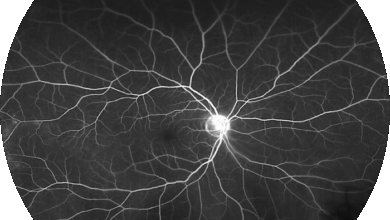 Retinal implant hope of cure for macular degeneration