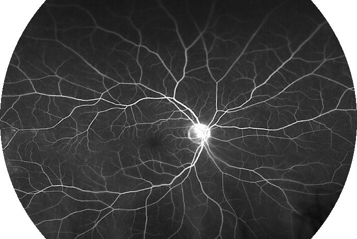 Retinal implant hope of cure for macular degeneration