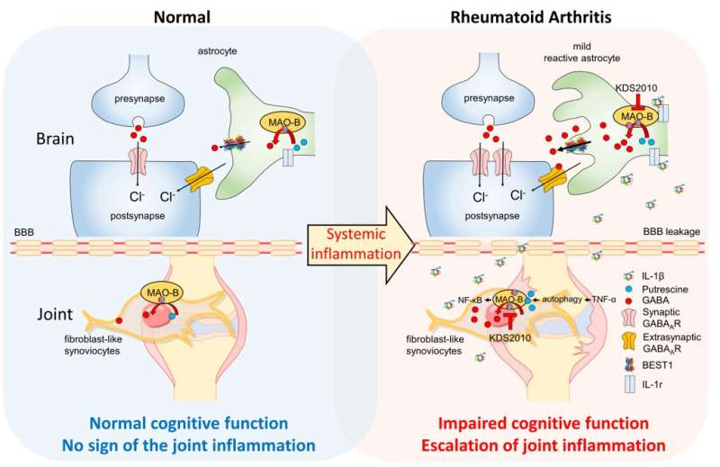 Study finds connection between migraine rheumatoid arthritis